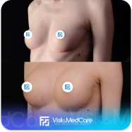 Double Buuble Breast Augmentation