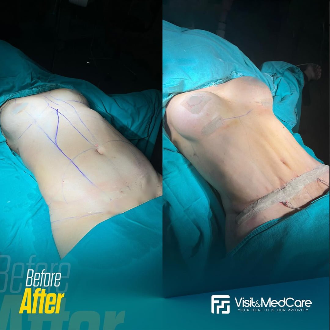 Mini Abdominoplasty Before and After Photos