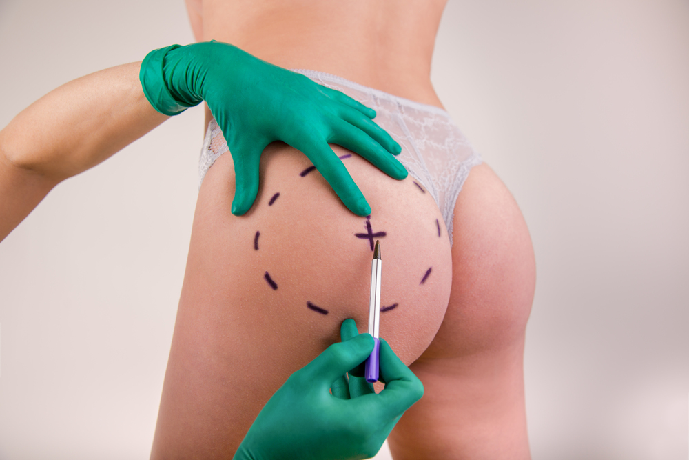 Mujer en el médico para hacerse un lipofilling de glúteos