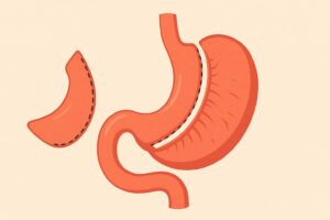 Efectos secundarios a largo plazo de la manga gástrica